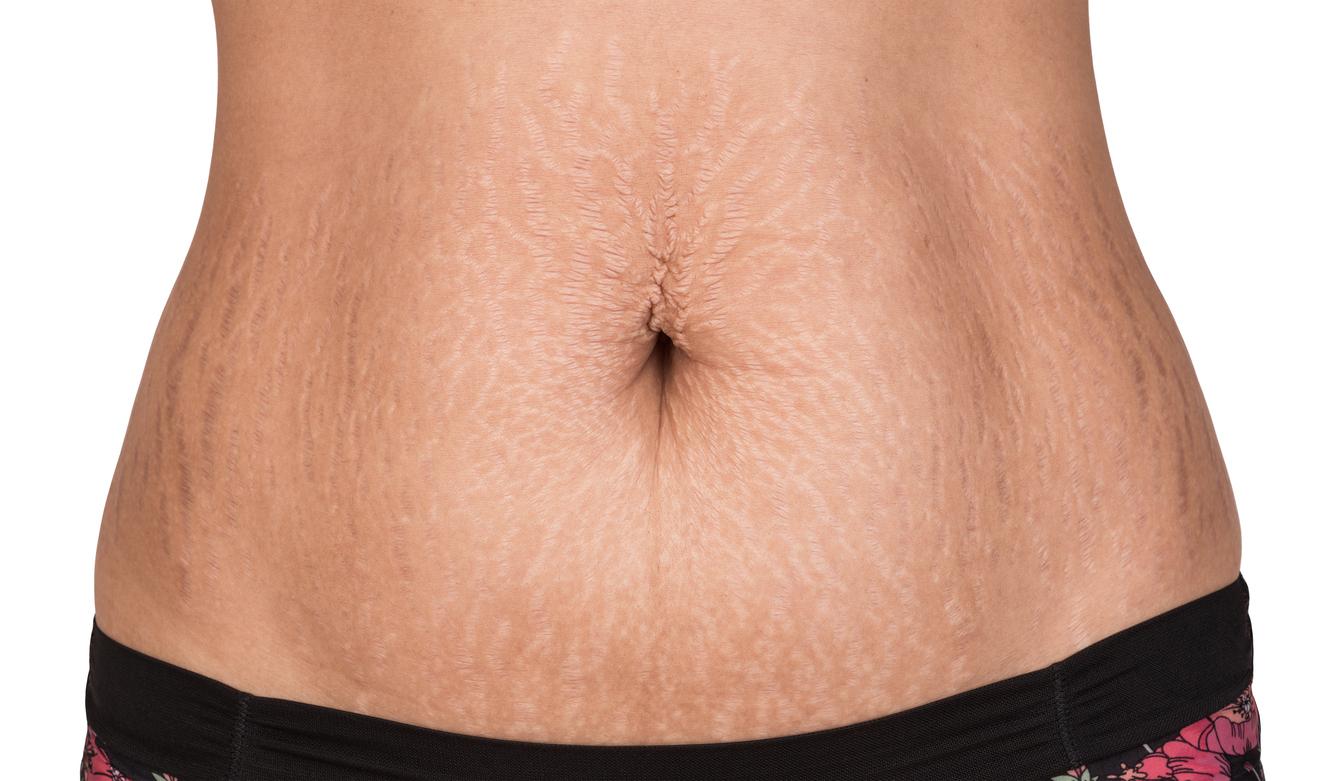 The Power of Concealment: Banishing Stretch Marks from Sight